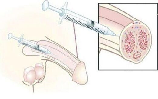Injoyment of hyaluronic acid injections