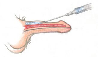 Injection of hyaluronic acid into the penis to increase volume